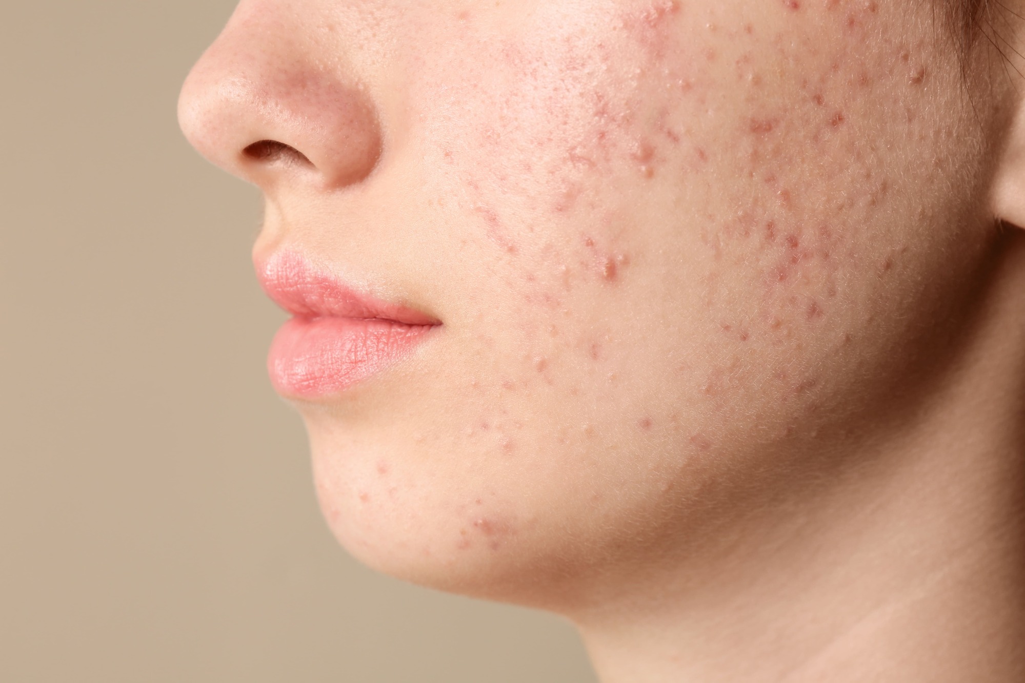 Avoiding the Mirror and Life: A Brighton Teen Finds Acne Relief with Naturopathic Care